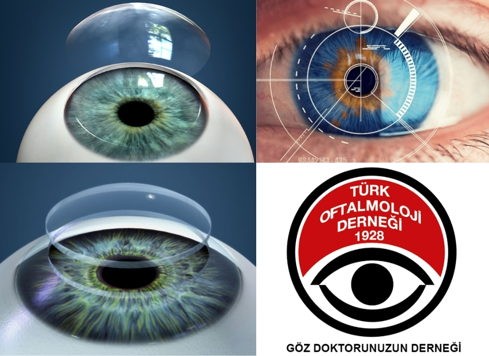 Kornea Nakliyle Yeniden Görme Umudu