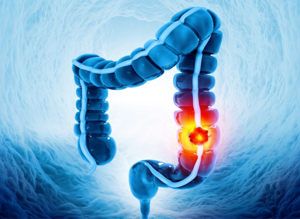 Colon Cancer Risk in Long-Term Ulcerative Colitis Requires Close Monitoring