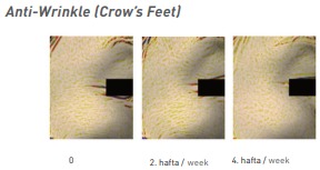 Anti-Wrinkle (Crow’s Feet)